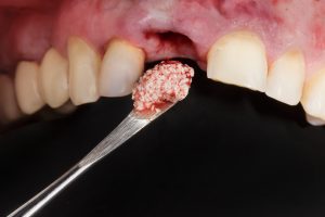 dental bone graft