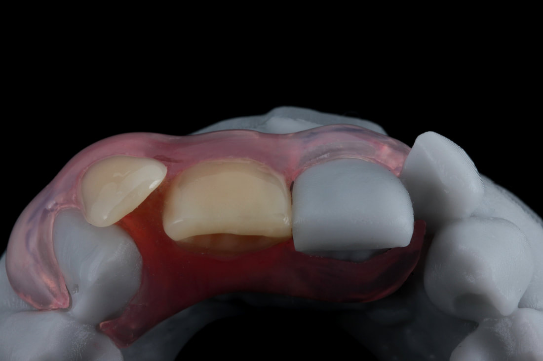 Valplast Dentures