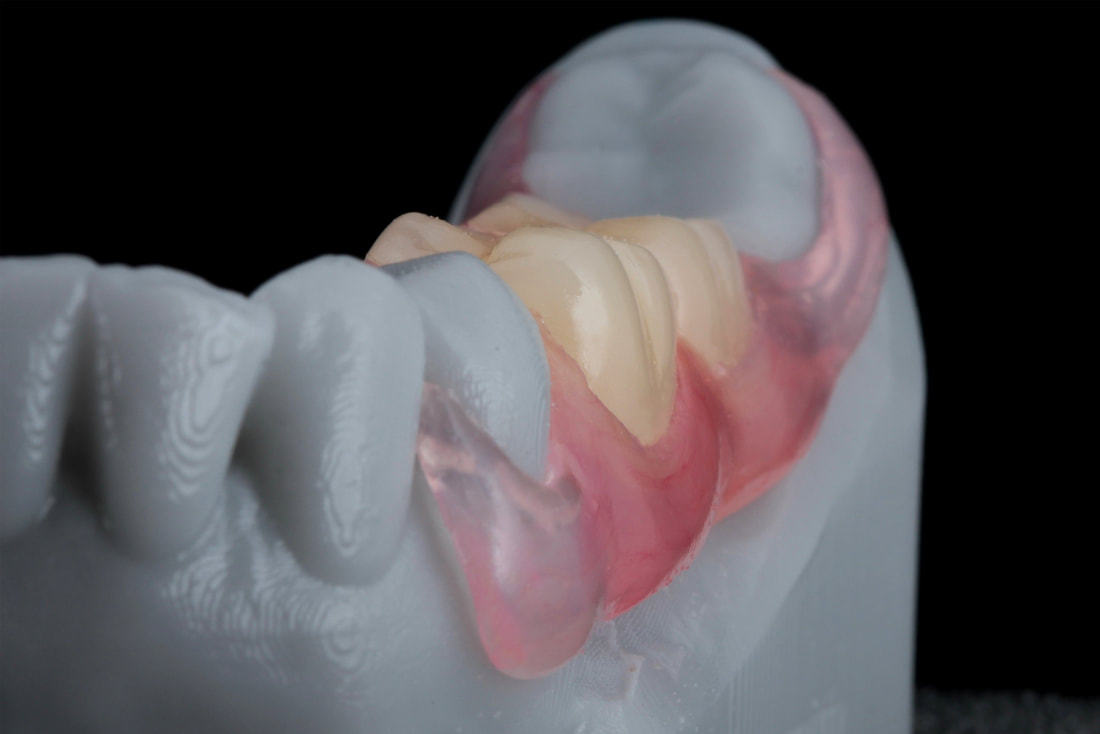 Valplast Dentures