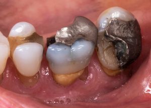 broken tooth