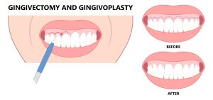crown lengthening surgery
