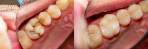 temporary fillings