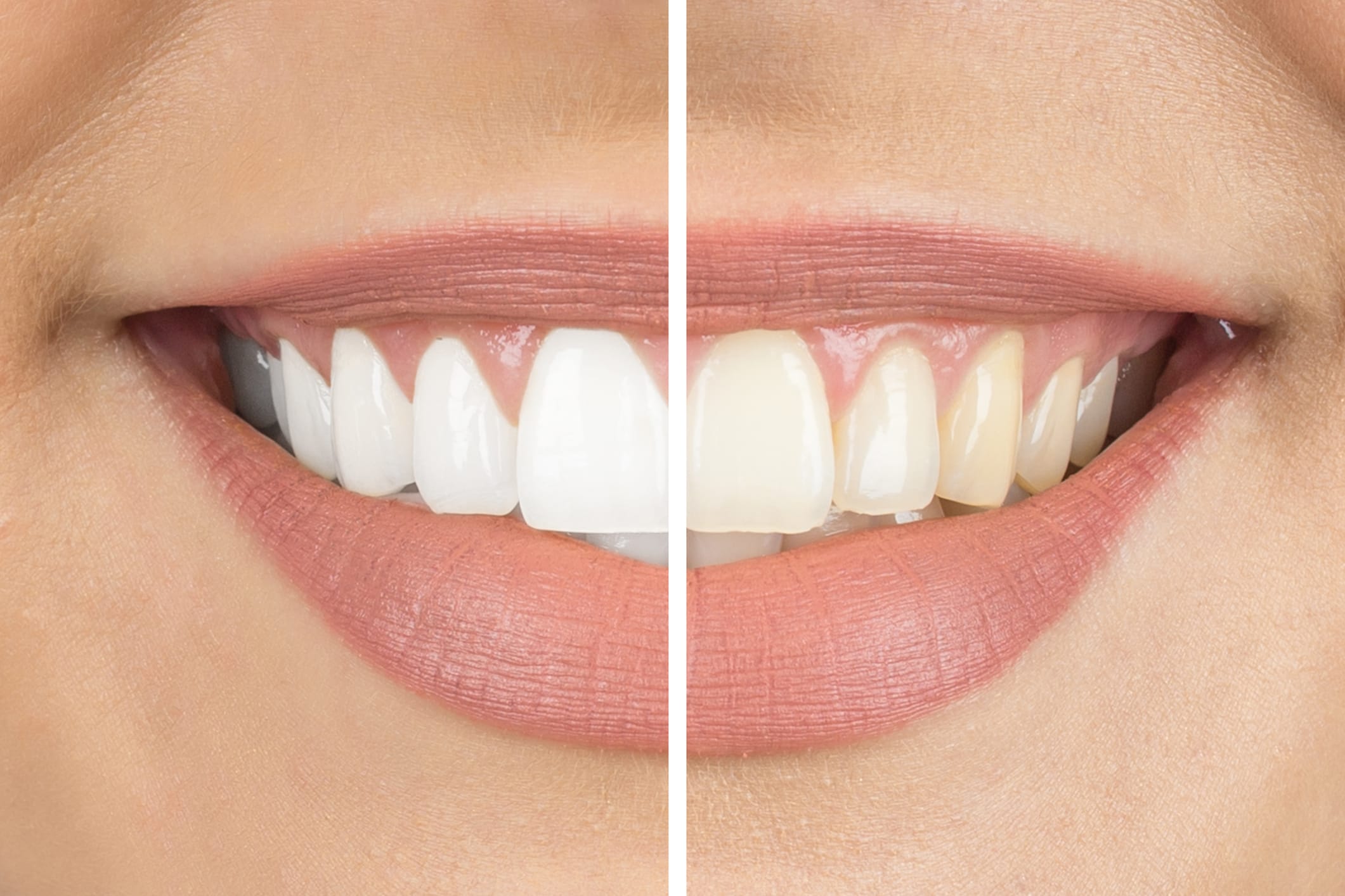 The benefits of professional teeth whitening in Wimbledon