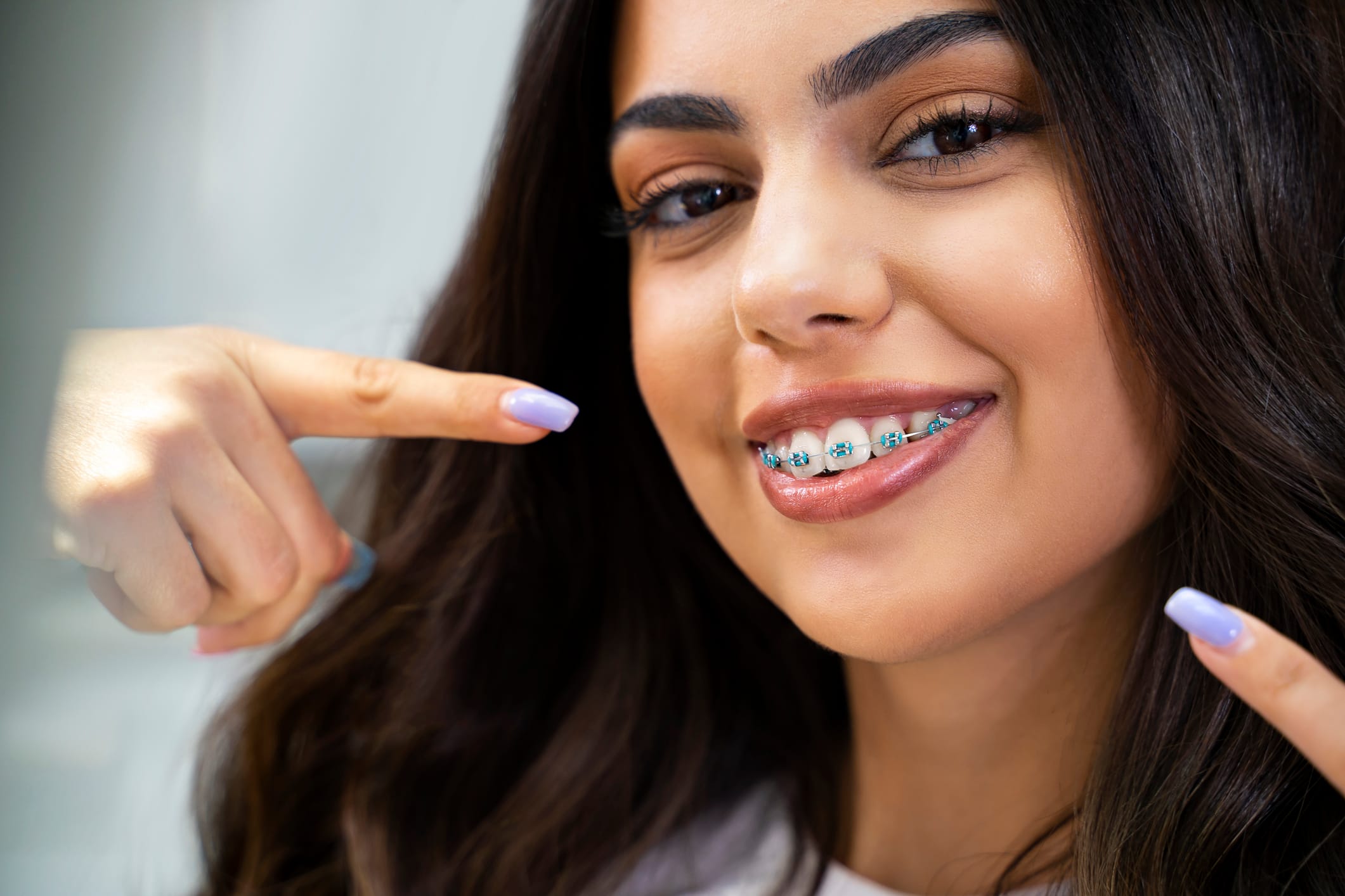 Unlocking your best smile: The power of fixed braces in Kingston Vale