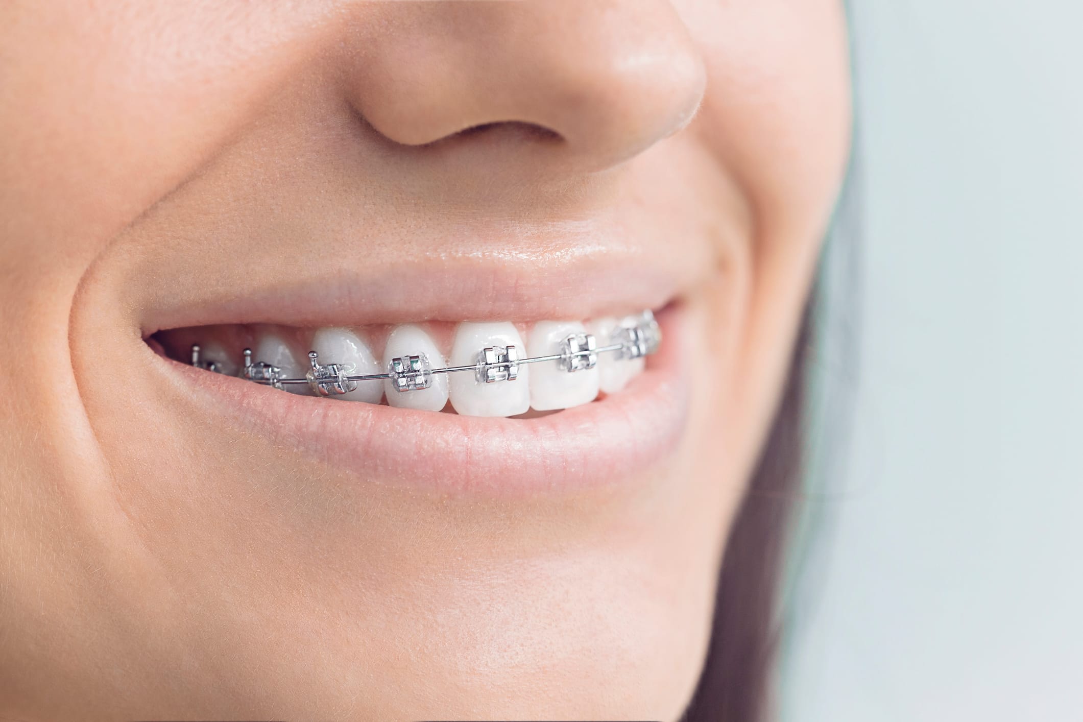 Unlocking your best smile: The power of fixed braces in Kingston Vale