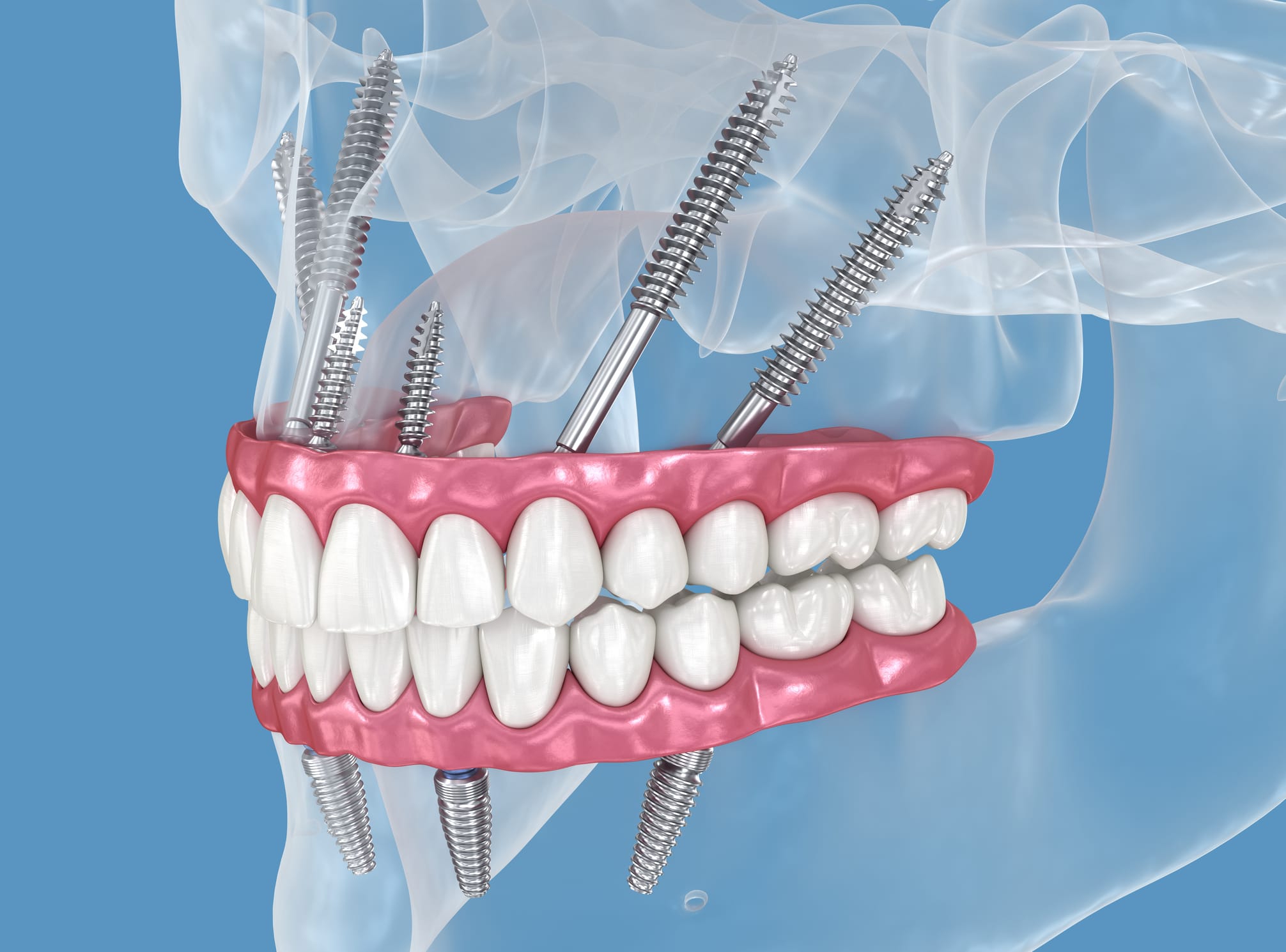 Zygomatic Implants: A solution for severe bone loss in Merton