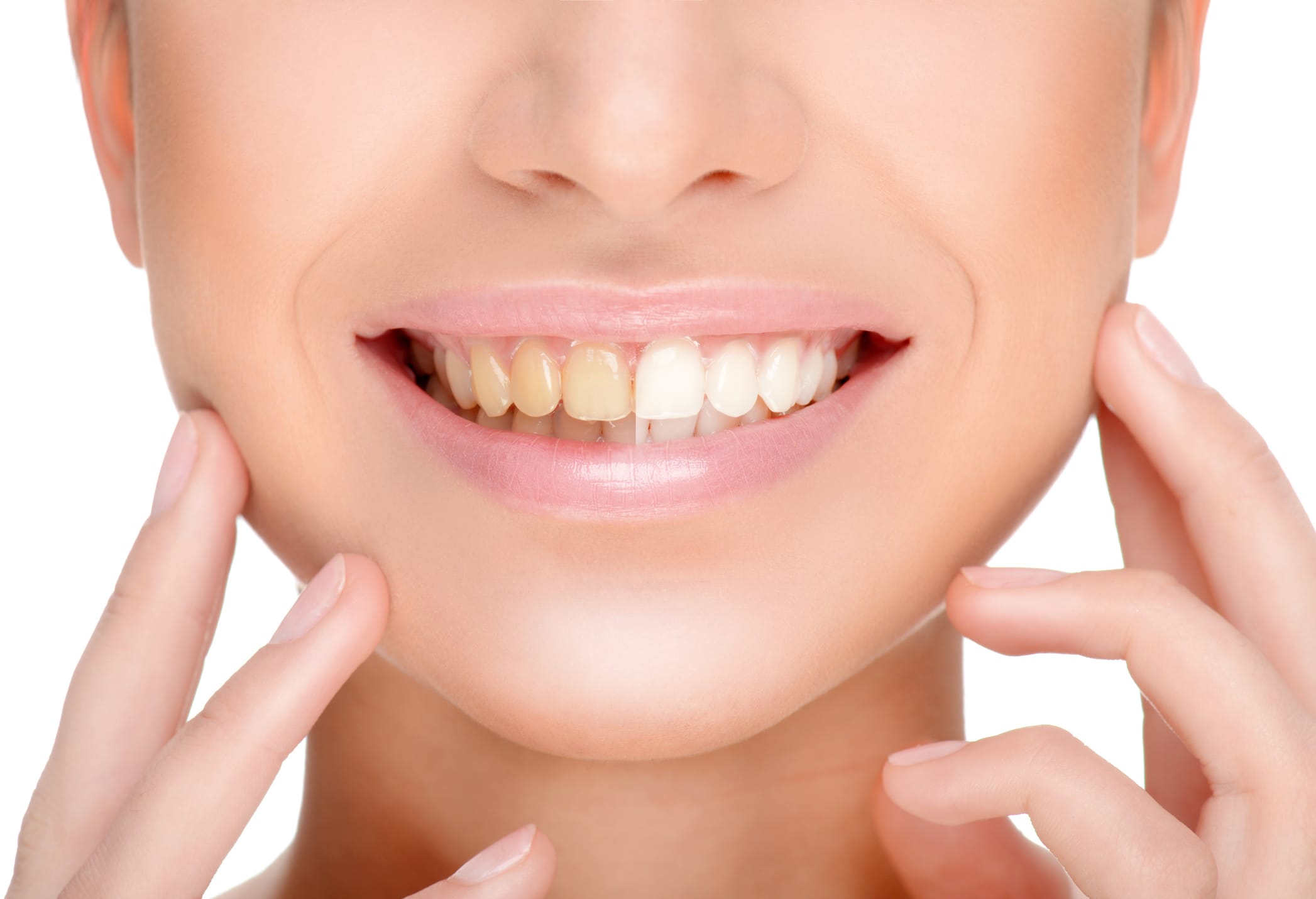 Smile makeovers: Transform your smile in Fulham