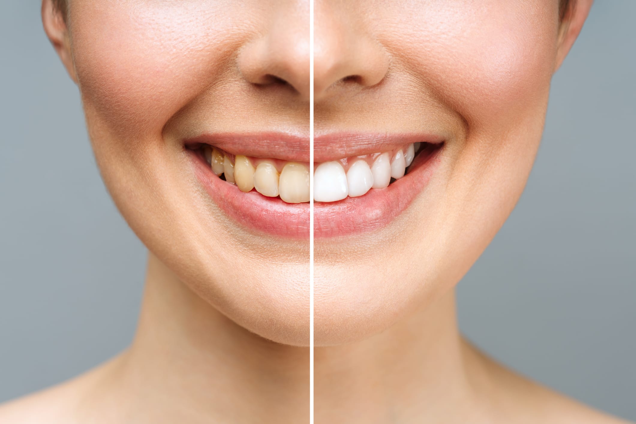 Teeth whitening in Tolworth: Brighten your smile safely and effectively