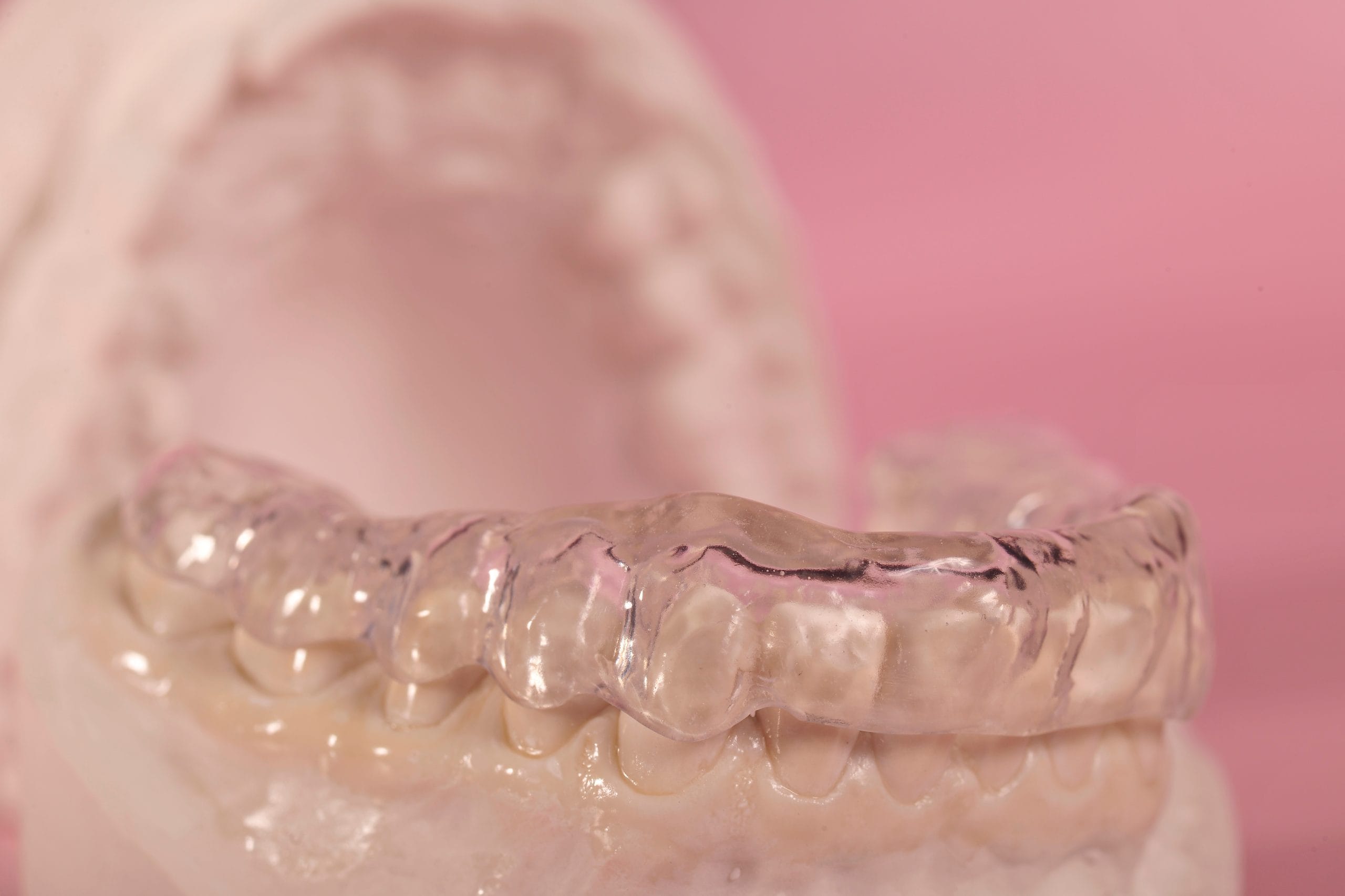 Protecting your smile with a Michigan splint in Merton