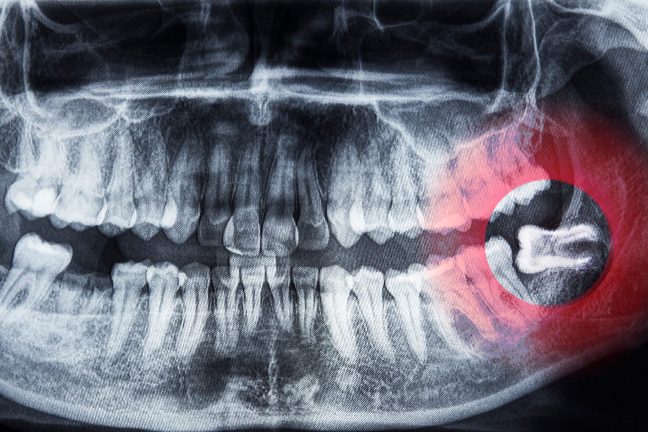 Should I have my wisdom teeth removed? Your guide to wisdom tooth extractions
