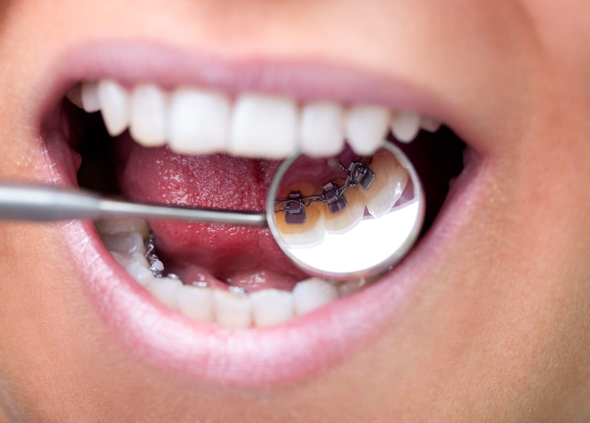 Maintaining your smile with permanent retainers in Hammersmith
