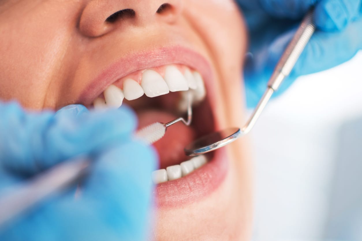 Maintaining oral health with guided biofilm therapy in Kingston