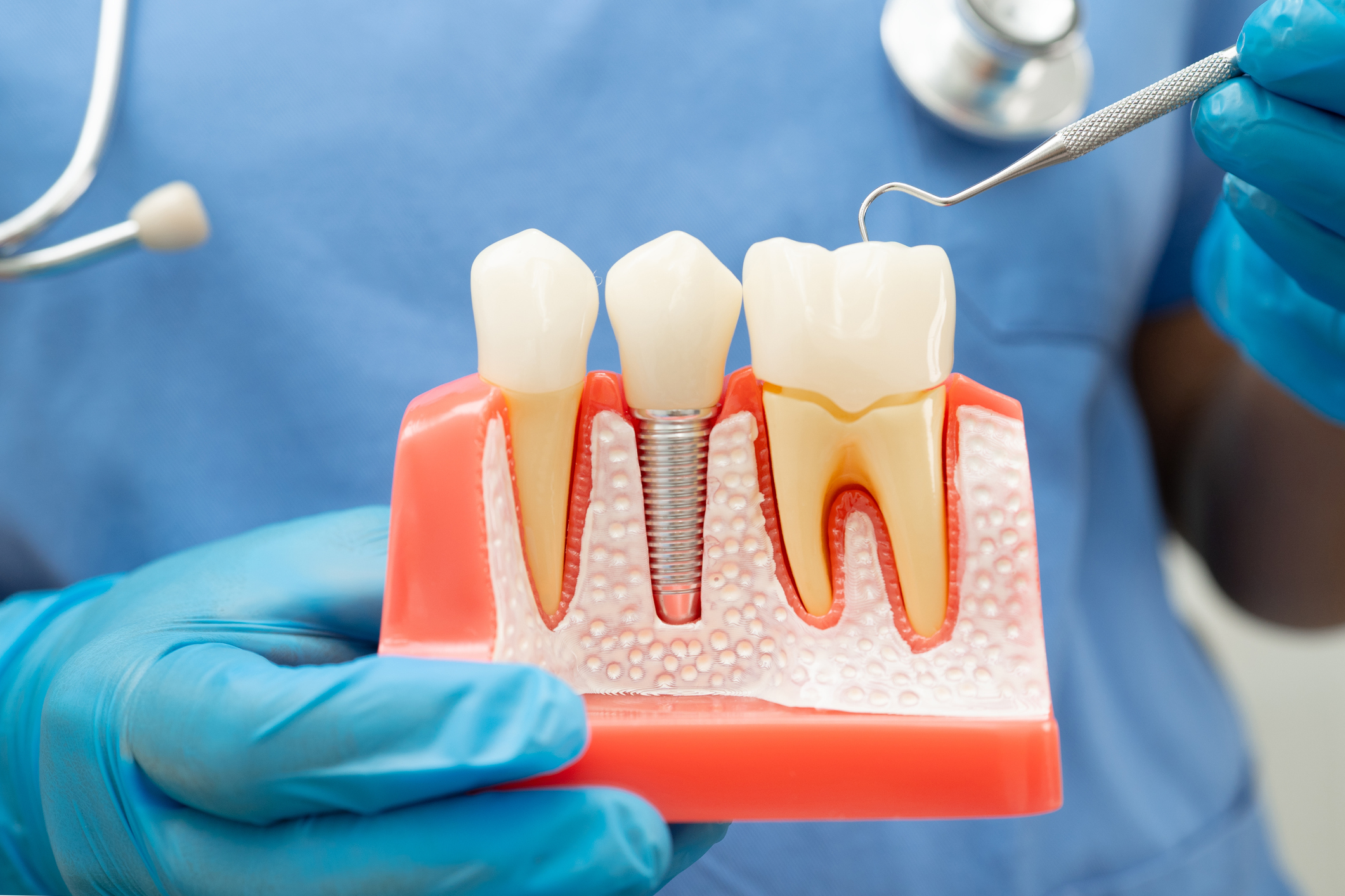 Zygomatic Dental Implants in London: Your specialist guide to new teeth, even with severe bone loss