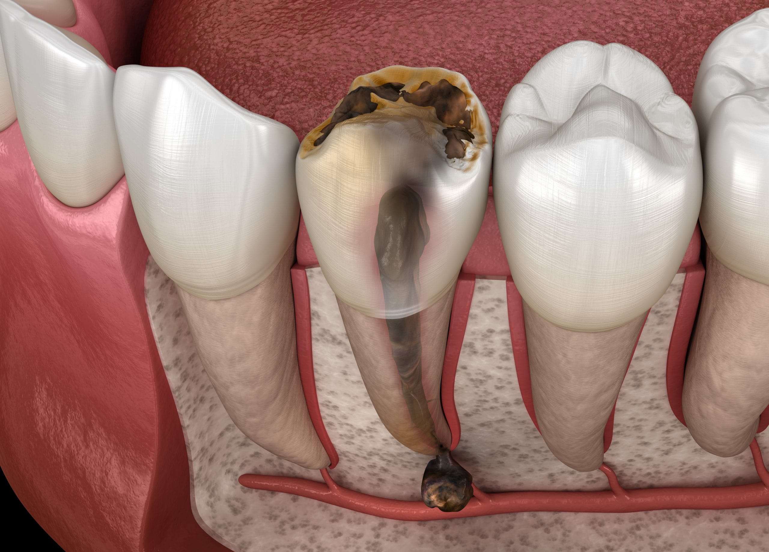 dental cyst