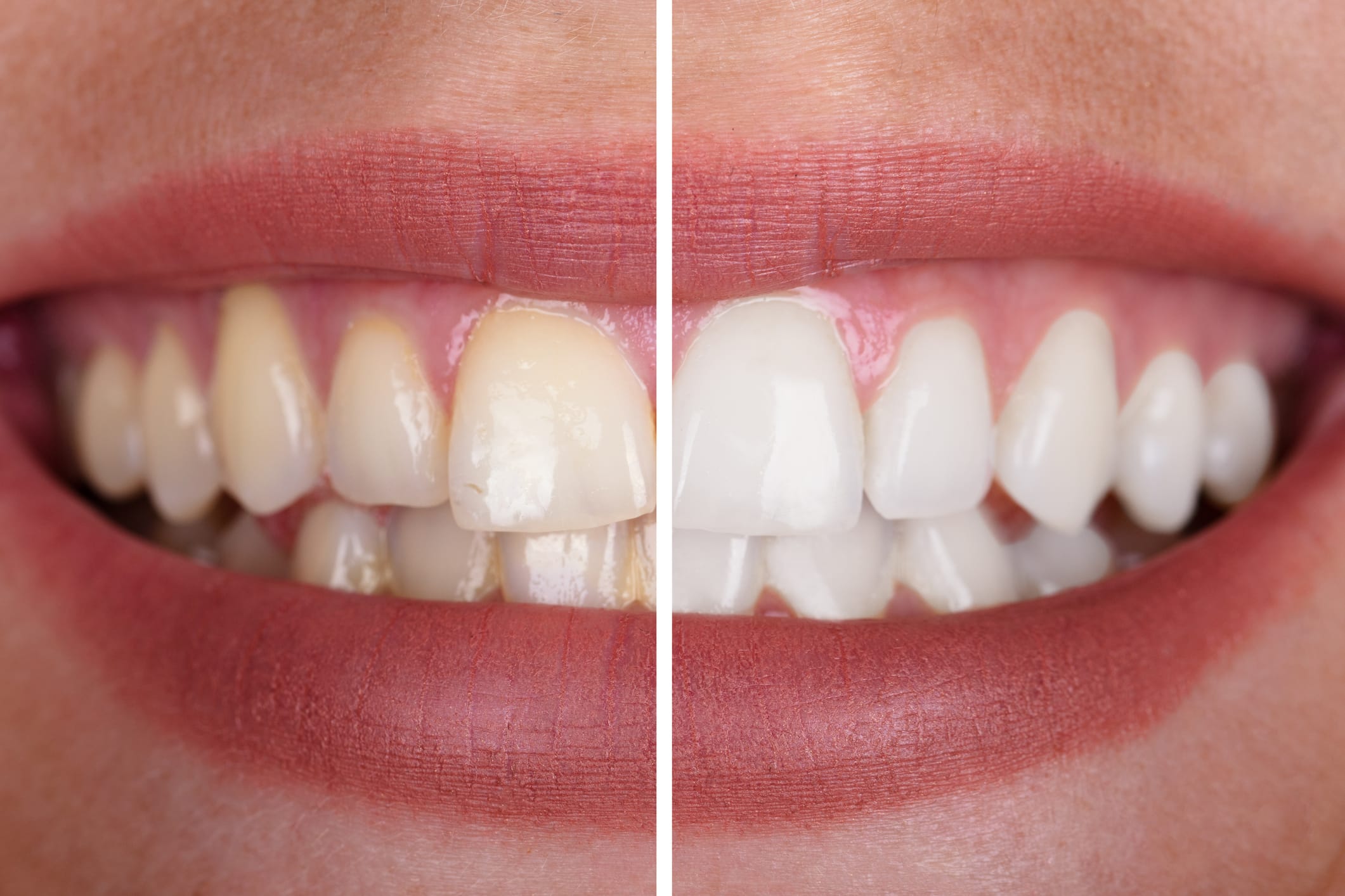 Brighten your smile in New Malden: How professional teeth whitening really works