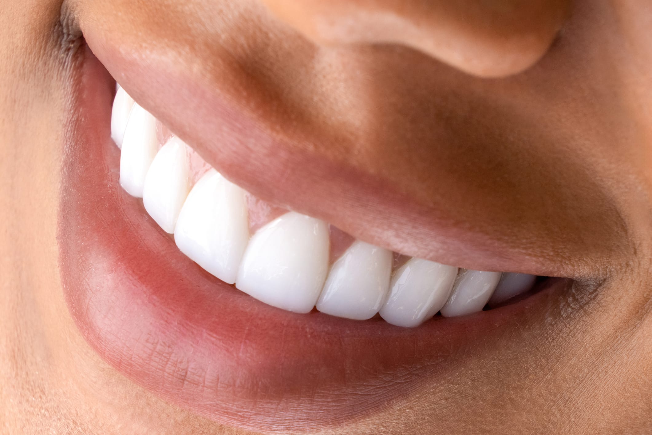Veneers in Sutton: Are they right for your perfect smile?