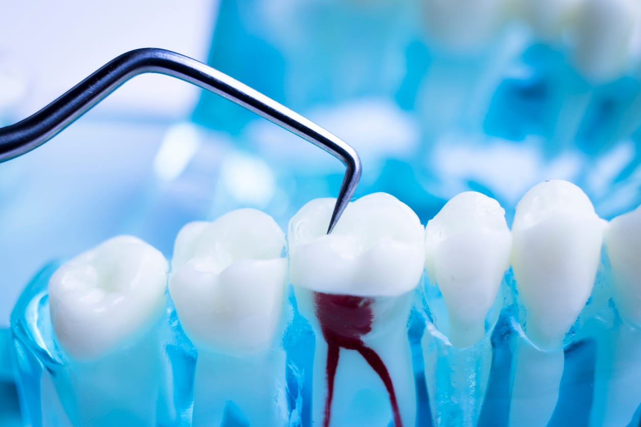 Endodontic appointment in Wimbledon