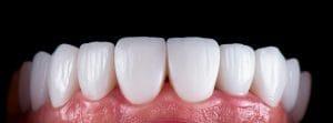 porcelain veneers
