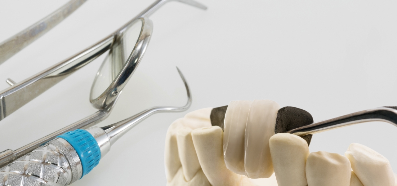 Adhesive Dental Bridges
