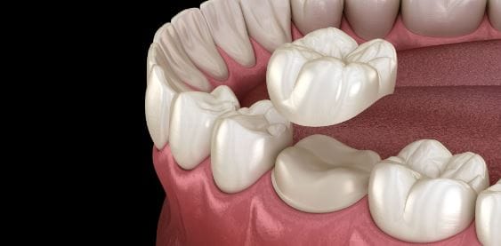 Mercury free dentistry (CEREC)