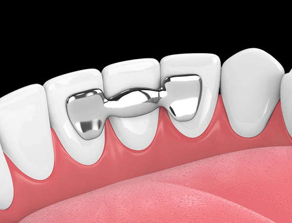 Adhesive Dental Bridges