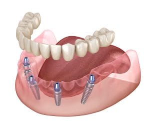 Fixed full-arch implants