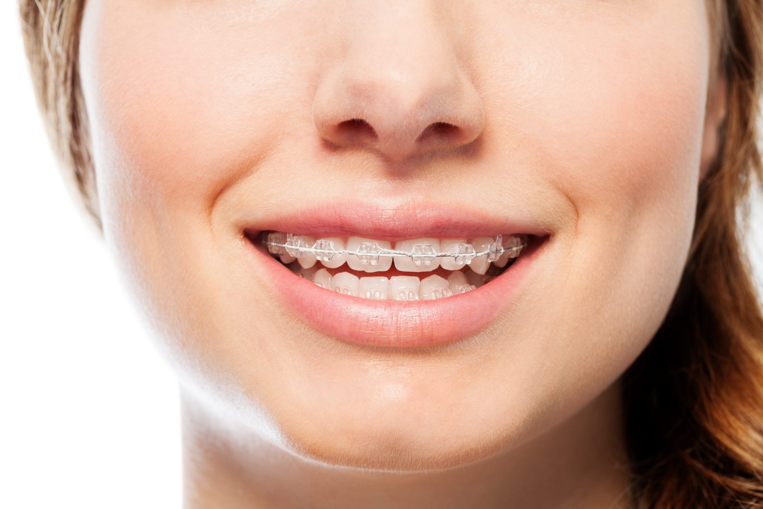fixed braces