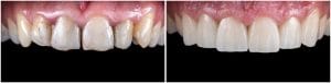 composite bonding vs veneers