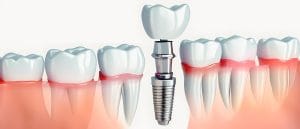 dental implant for cracked tooth replacement