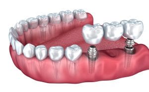dental implants