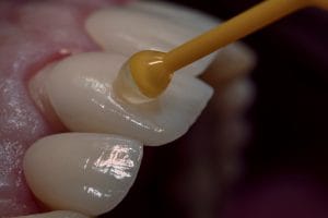 fitting porcelain veneer