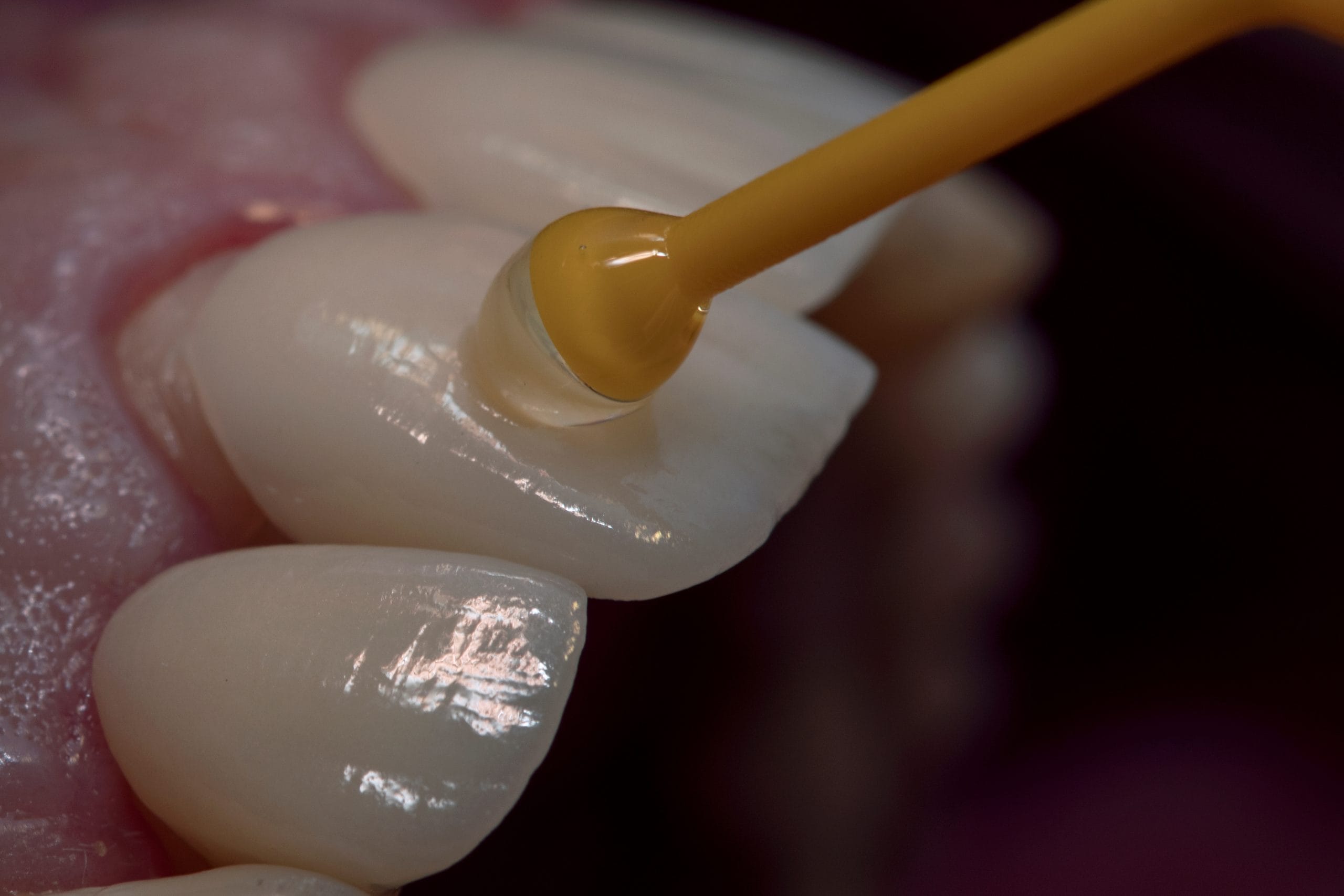 fitting porcelain veneer