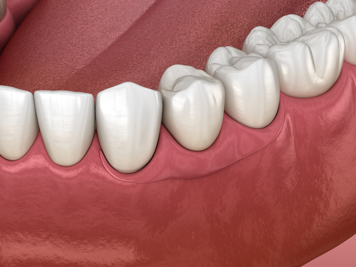 Immediate Dentures