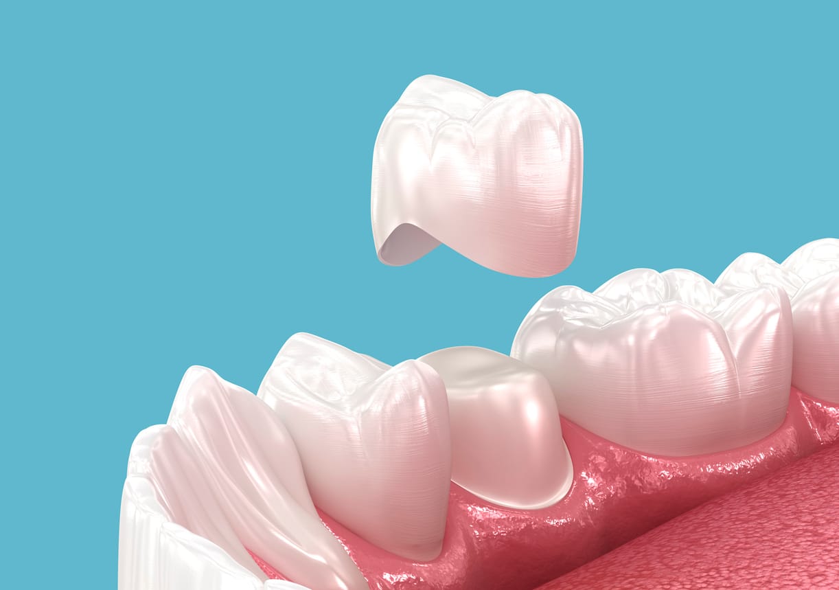 Same day Crowns