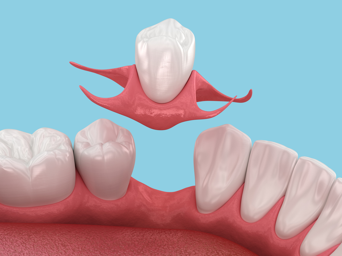 Immediate Dentures