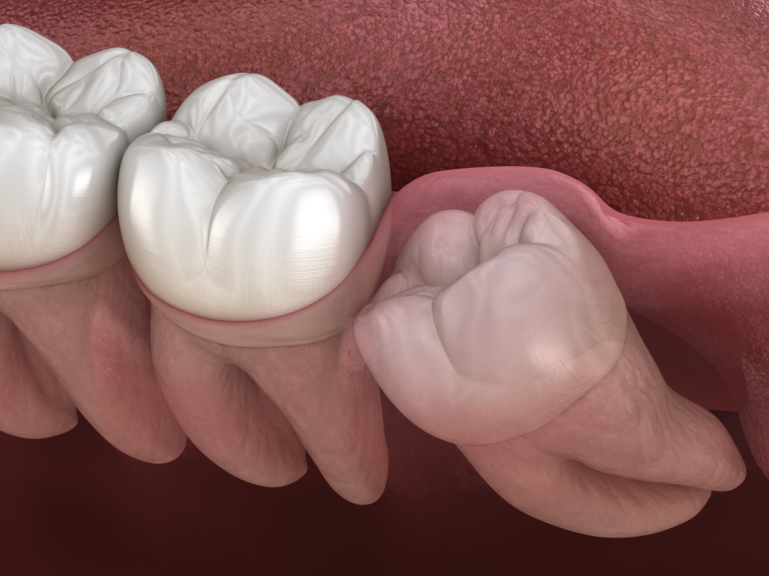 impacted wisdom tooth