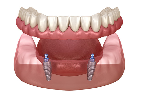Dental Implant Dentures