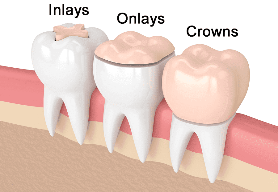 Same day Crowns