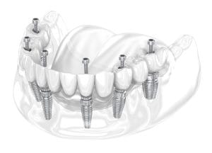 Implant-retained denture