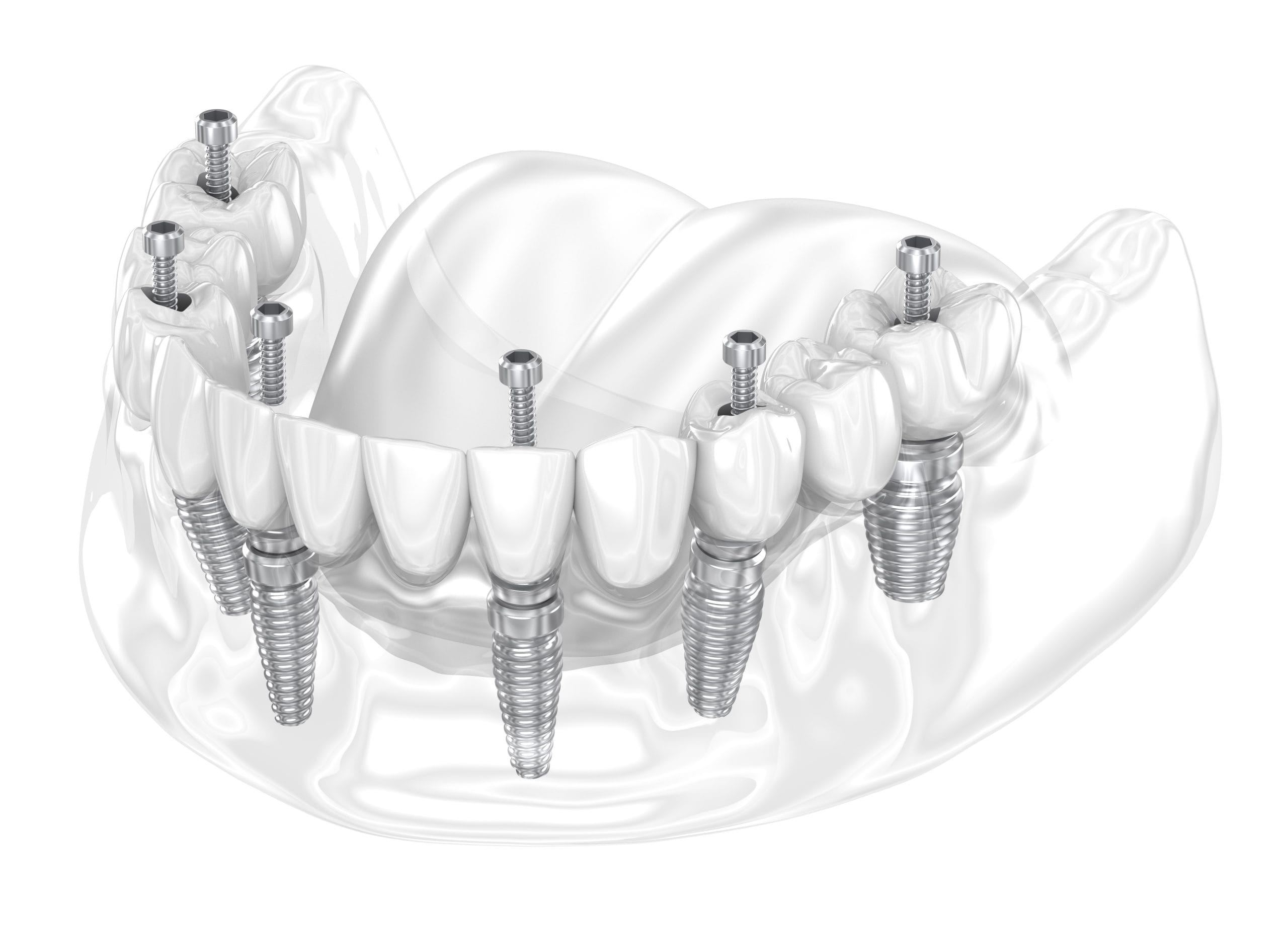 overdenture