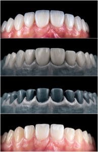 porcelain veneers before & after