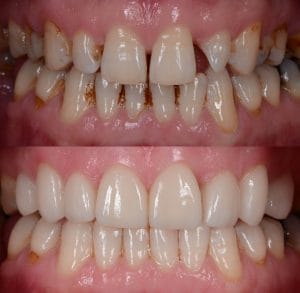 natural looking smile makeover