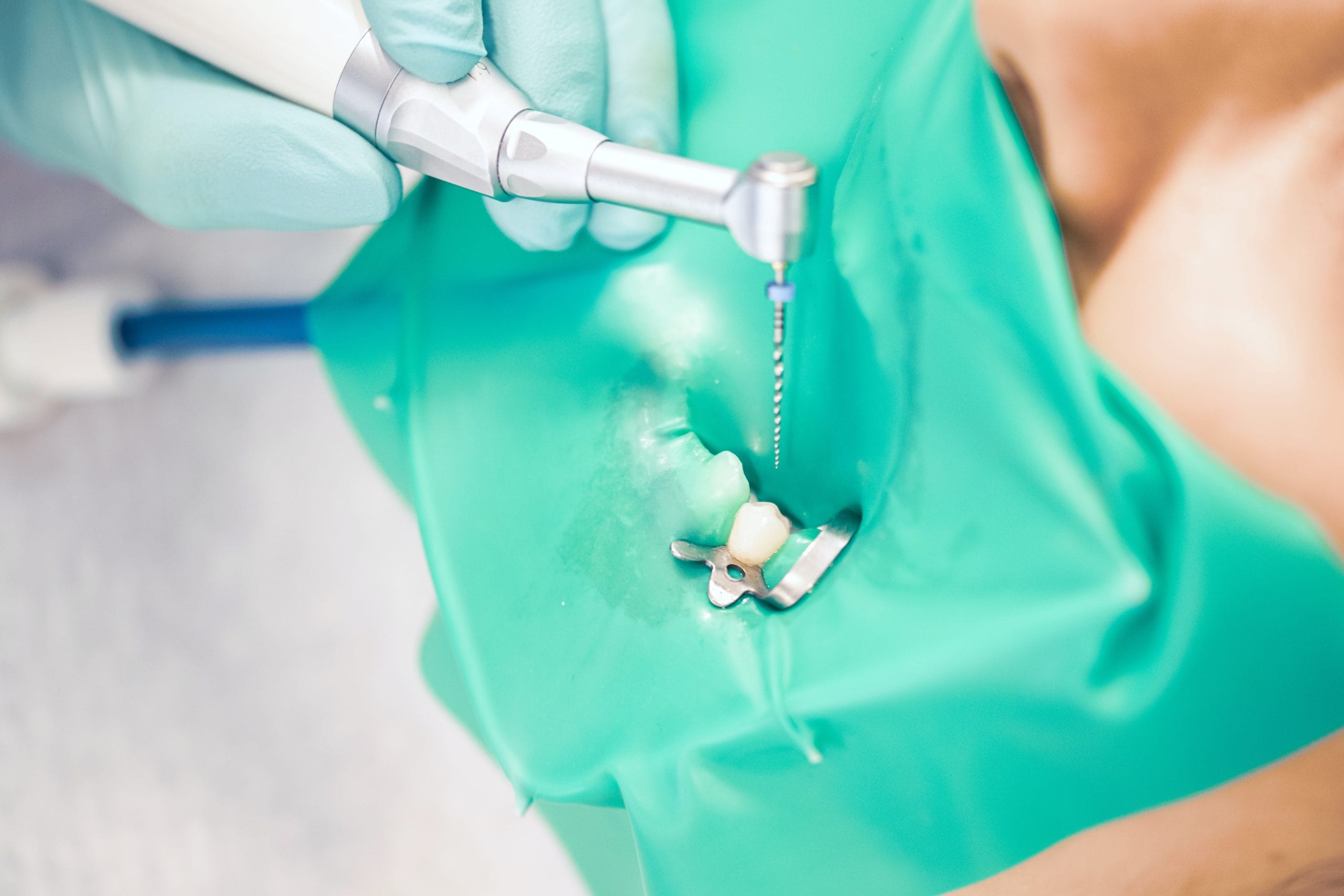 Pulp Extirpation