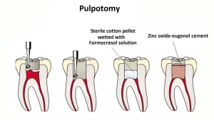 pulpotomy explained