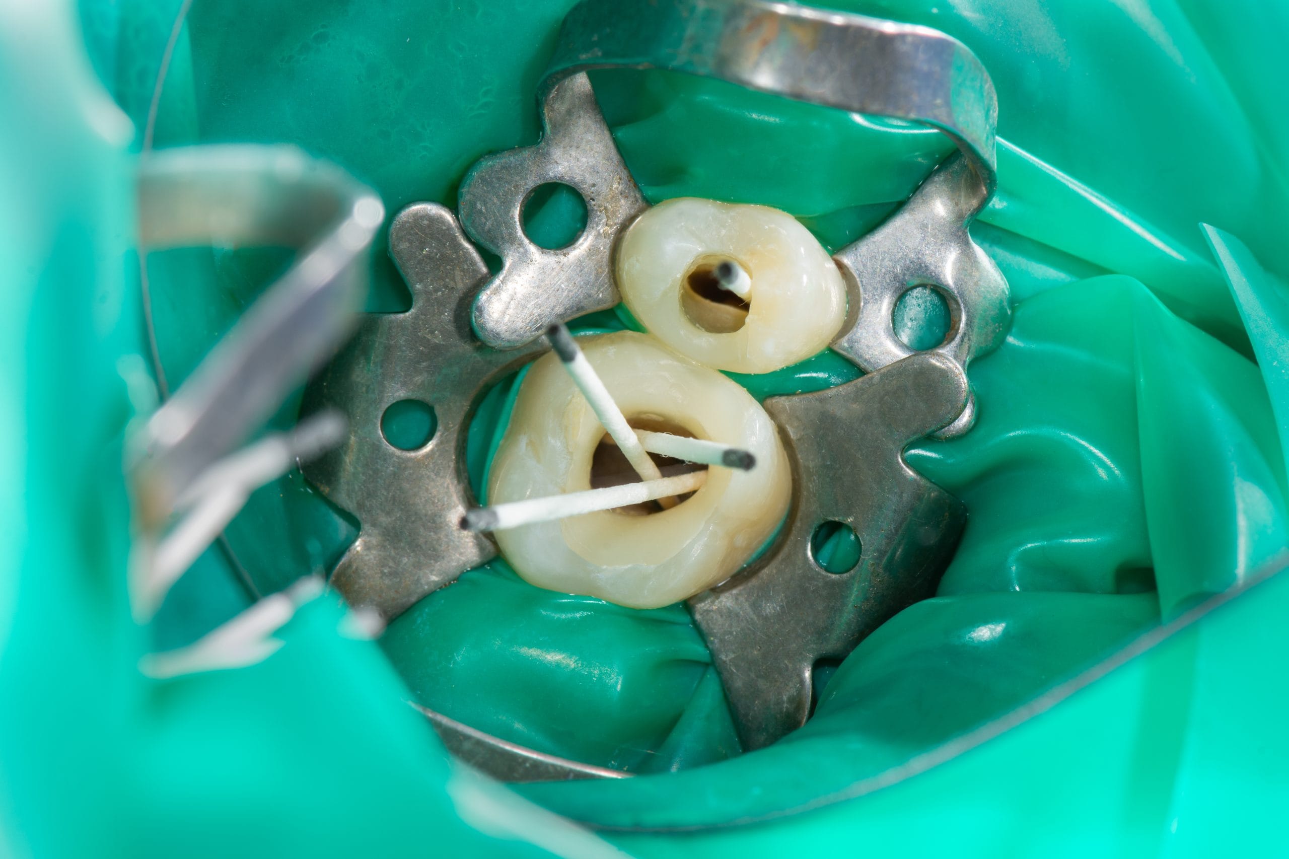 root canal cost