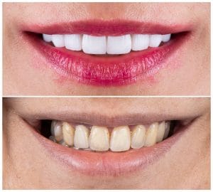 smile makeover