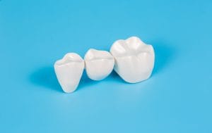 tooth bridge