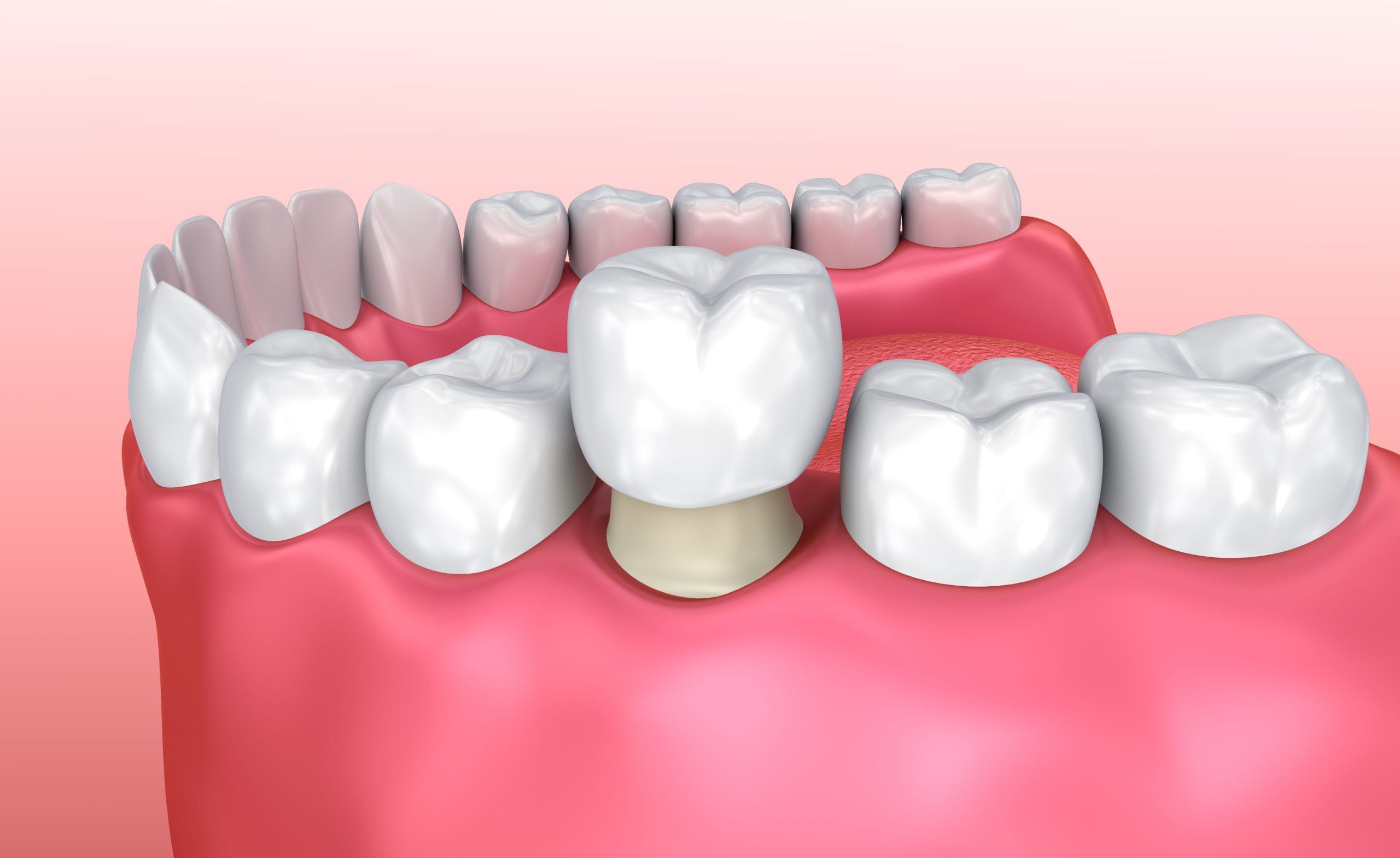 tooth crown
