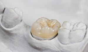 tooth crown