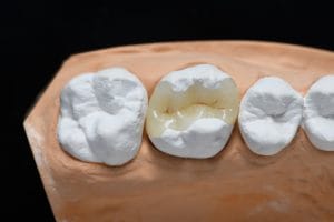 tooth inlay